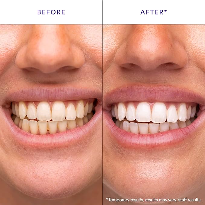 🦷✨ Teeth Whitening Strips Sale — 🔥🔥🔥 Up to 50% OFF