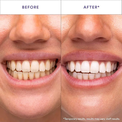 🦷✨ Teeth Whitening Strips Sale — 🔥🔥🔥 Up to 50% OFF