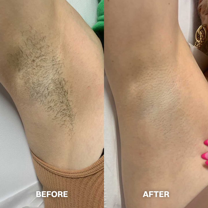 ✨ Gentle Hair Removal Cream for Women & Men – Fast & Painless